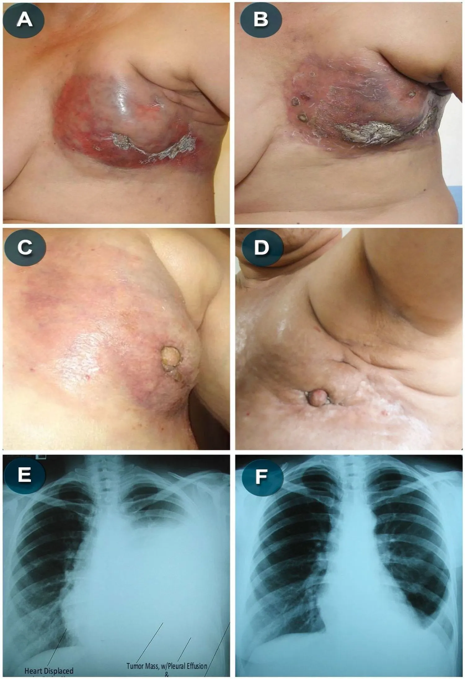 Secuencia clínica de Alejandra con imágenes de mama y estudios radiológicos de tórax antes y después del tratamiento.